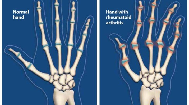 what is Rheumatoid Arthritis