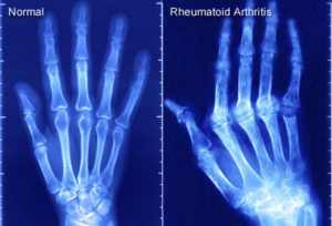 Rheumatoid Arthritis clinical trials