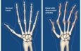 Rheumatoid Arthritis- what is it